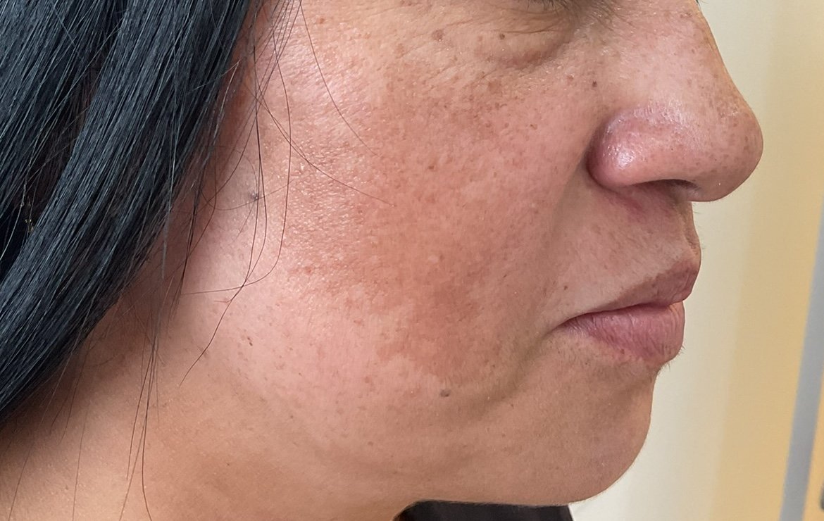 Melasma (Solo foto de la mancha) Melasma (Solo foto de la mancha)